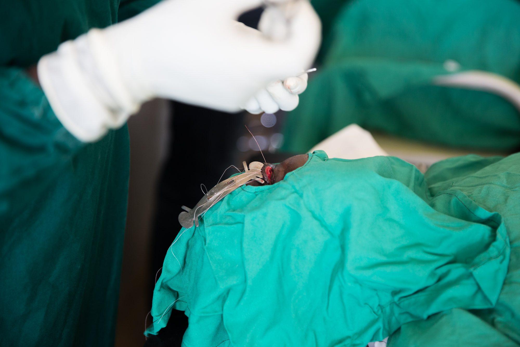 Trichiasis Surgery — photograph 15